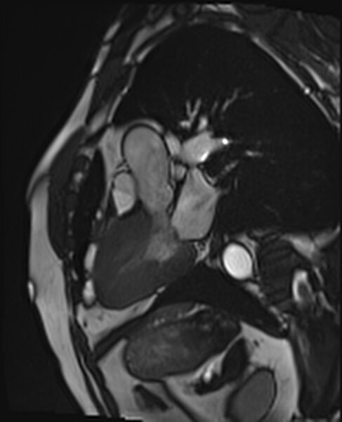 File:Asymmetric septal hypertrophic cardiomyopathy - systolic anterior motion of mitral leaflet (Radiopaedia 72795-83445 B 7).jpg