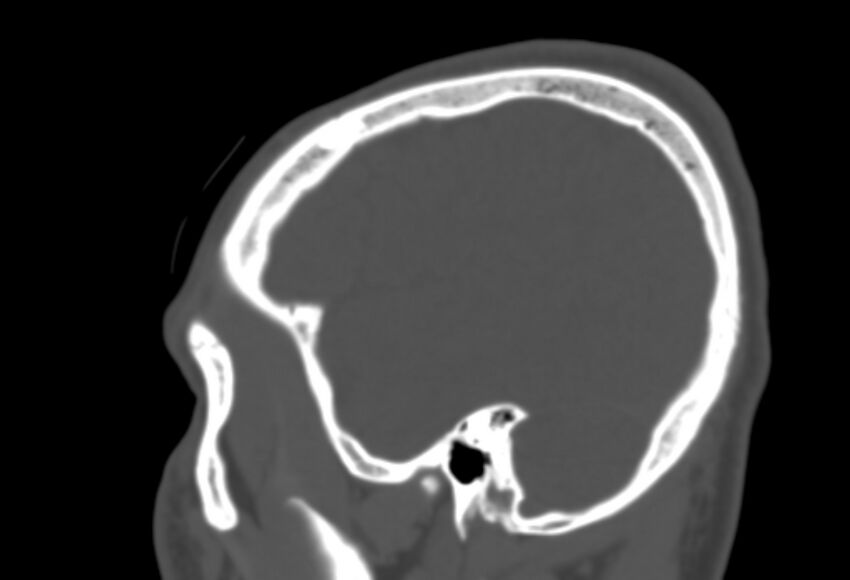 Asymptomatic occipital spur (Radiopaedia 87753-104201 Sagittal bone window 256).jpg