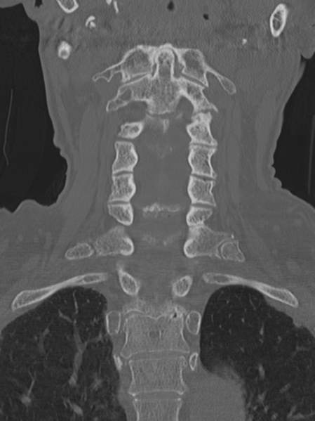 File:Atlanto-axial subluxation (Radiopaedia 36610-38176 Coronal bone window 24).png