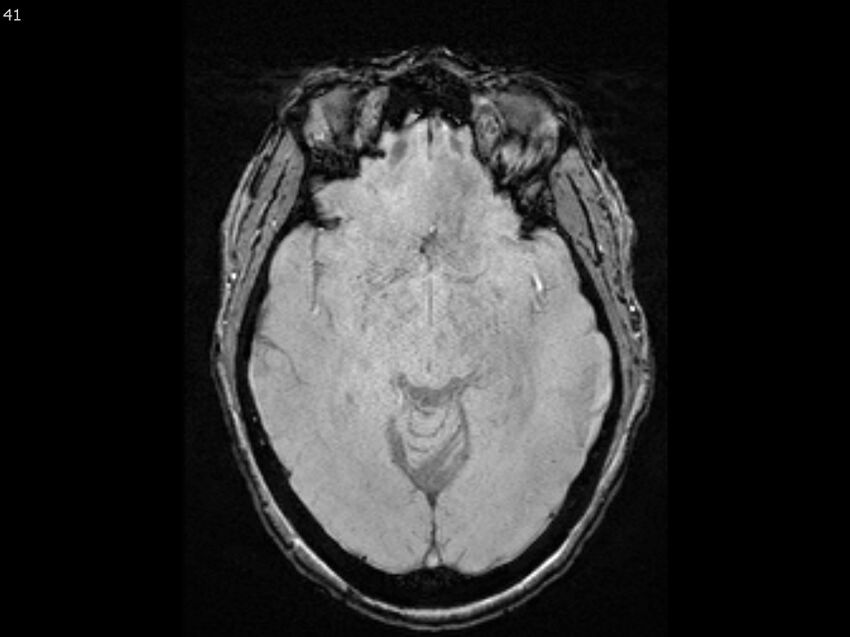 Atypical meningioma - intraosseous (Radiopaedia 64915-74572 Axial SWI 41).jpg
