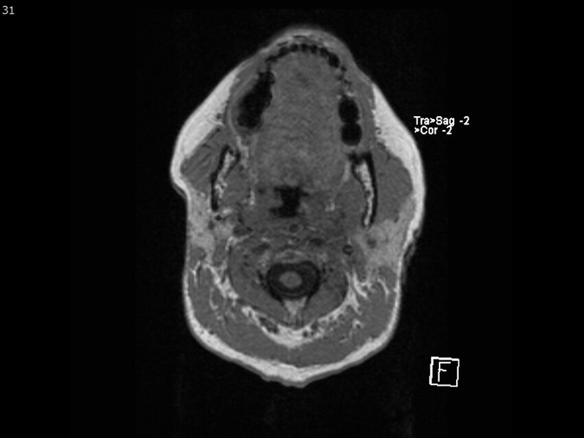 Atypical meningioma - intraosseous (Radiopaedia 64915-74572 Axial T1 31).jpg