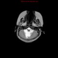 Atypical teratoid rhabdoid tumor (Radiopaedia 10712-11183 Axial T2 16).jpg