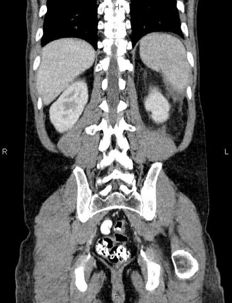 File:Autoimmune pancreatitis (Radiopaedia 84925-100431 D 49).jpg