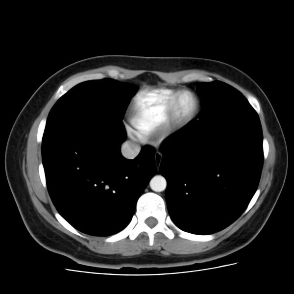 File:Autosomal dominant polycystic kidney disease (Radiopaedia 23061-23093 B 4).jpg