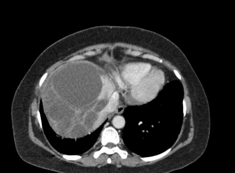 File:Autosomal dominant polycystic kidney disease (Radiopaedia 57124-64017 A 18).jpg