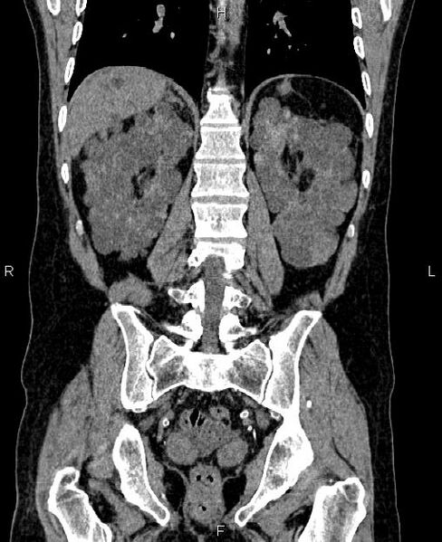 File:Autosomal dominant polycystic kidney disease (Radiopaedia 87830-104287 Coronal non-contrast 45).jpg