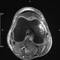 Avulsion fracture of the fibular head (Radiopaedia 74804-85808 Axial PD fat sat 17).jpg