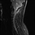 Axis fracture - MRI (Radiopaedia 71925-82375 Sagittal STIR 6).jpg