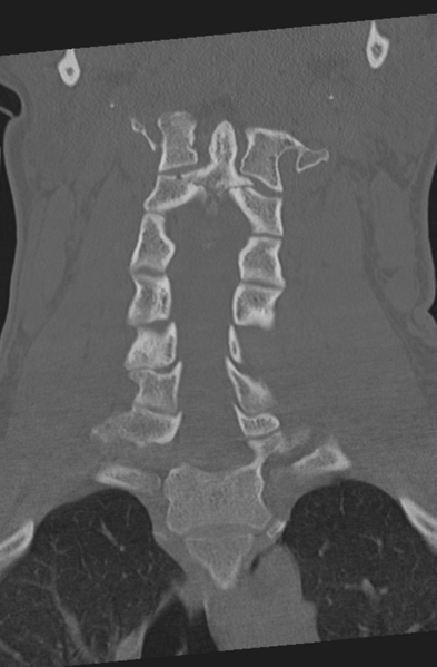 File:Axis peg fracture (type 3) and atlas lateral mass (type 4) fracture (Radiopaedia 37474-39324 Coronal bone window 22).png