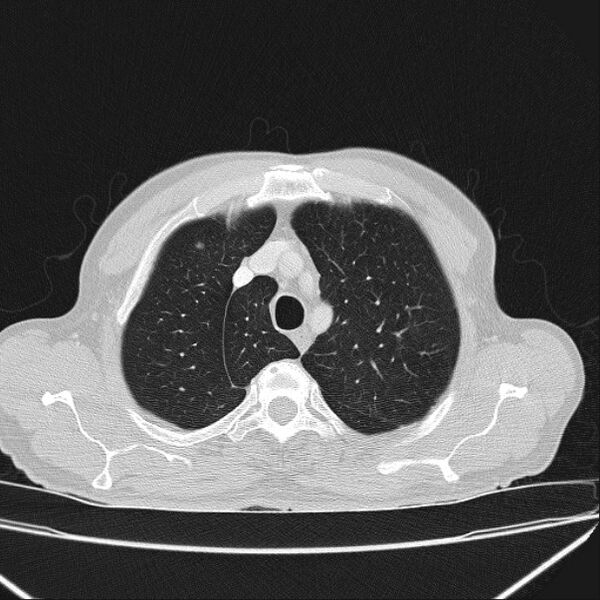 File:Azygos lobe (Radiopaedia 38259-40275 Axial lung window 15).jpg