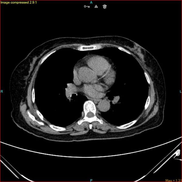 File:Azygos vein aneurysm (Radiopaedia 77824-90130 A 32).jpg
