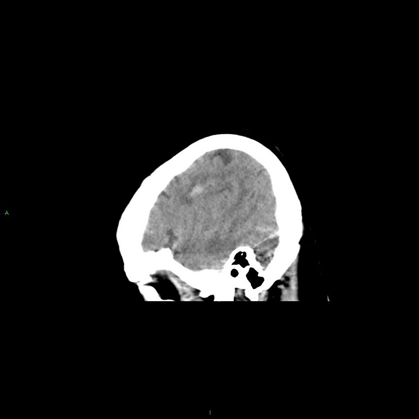 Basal ganglia hemorrhage (Radiopaedia 58349-65472 C 44).jpg