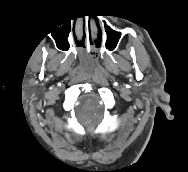 File:Basal ganglia hemorrhage (Radiopaedia 58763-65985 D 13).jpg
