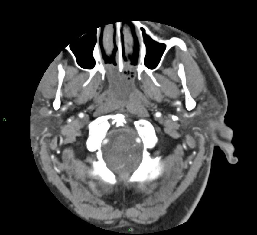 Basal ganglia hemorrhage (Radiopaedia 58763-65985 D 13).jpg