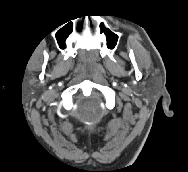 File:Basal ganglia hemorrhage (Radiopaedia 58763-65985 D 7).jpg