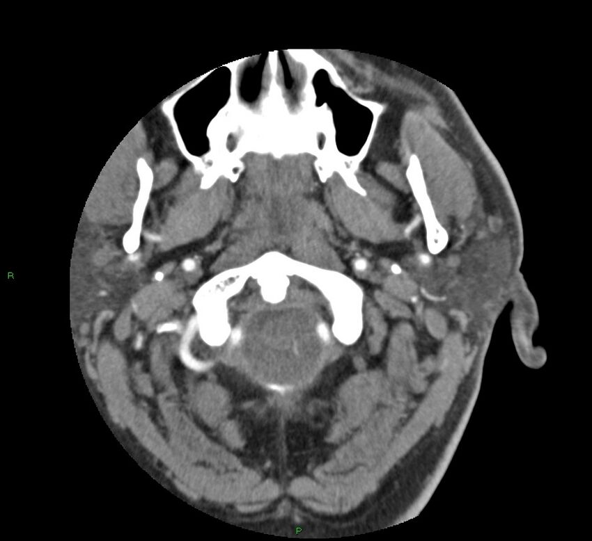 Basal ganglia hemorrhage (Radiopaedia 58763-65985 D 7).jpg
