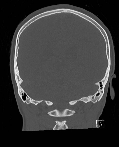 File:Base of skull fracture with bilateral Le Fort fractures (Radiopaedia 47094-51638 Coronal bone window 31).jpg