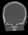 Base of skull fracture with bilateral Le Fort fractures (Radiopaedia 47094-51638 Coronal bone window 31).jpg