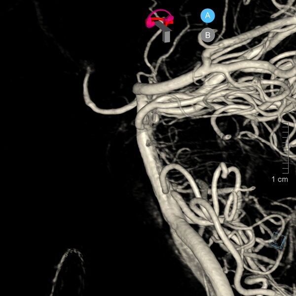 File:Basilar artery perforator aneurysm (Radiopaedia 82455-97734 3D view left VA 19).jpg