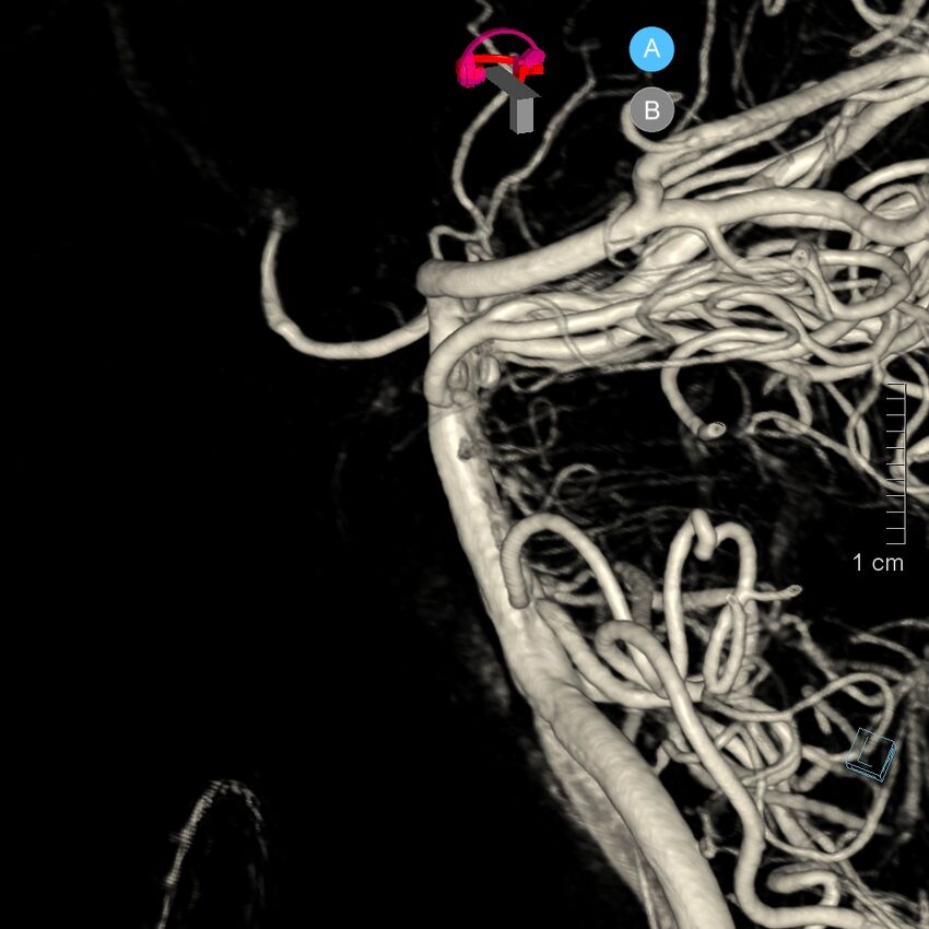 Basilar artery perforator aneurysm (Radiopaedia 82455-97734 3D view left VA 19).jpg