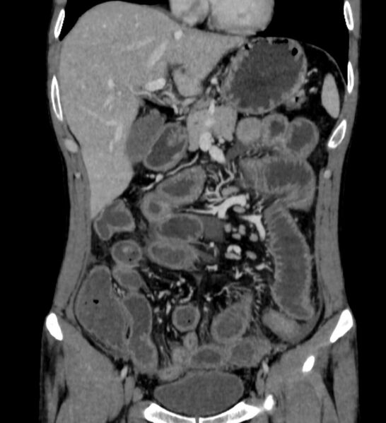 File:Behçet's disease- abdominal vasculitis (Radiopaedia 55955-62570 B 18).jpg