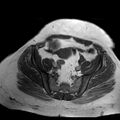 Benign seromucinous cystadenoma of the ovary (Radiopaedia 71065-81300 Axial T1 12).jpg