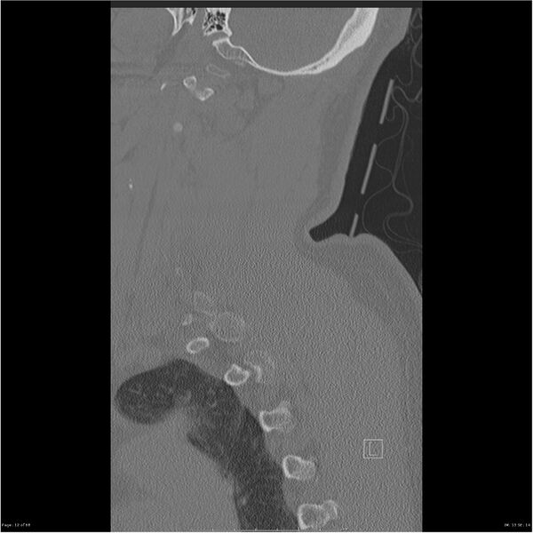 File:Bilateral cervical ribs (Radiopaedia 25868-26017 Sagittal bone window 12).jpg