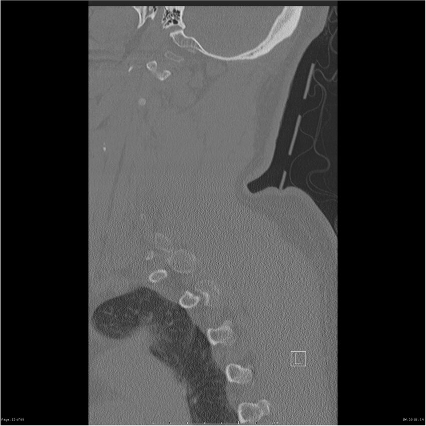 Bilateral cervical ribs (Radiopaedia 25868-26017 Sagittal bone window 12).jpg