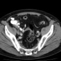 Bilateral direct inguinal herniae (Radiopaedia 17016-16719 B 6).jpg