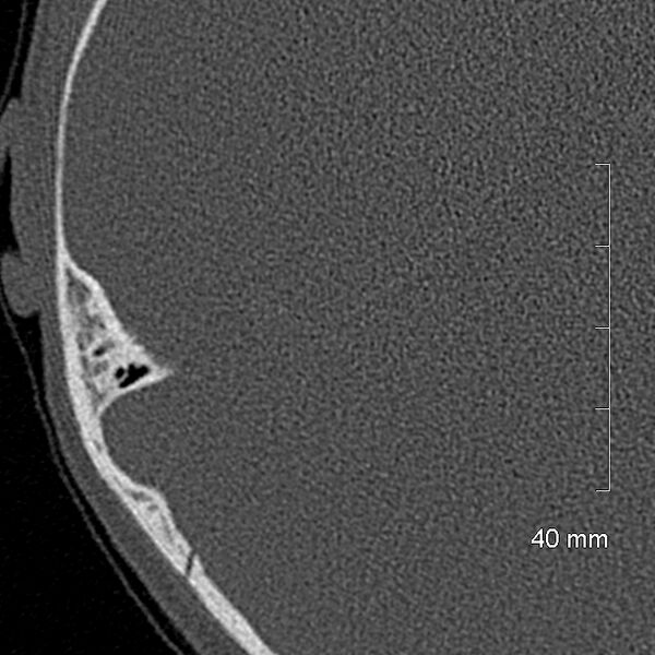 File:Bilateral grommets (Radiopaedia 47710-52404 Axial bone window 65).jpg