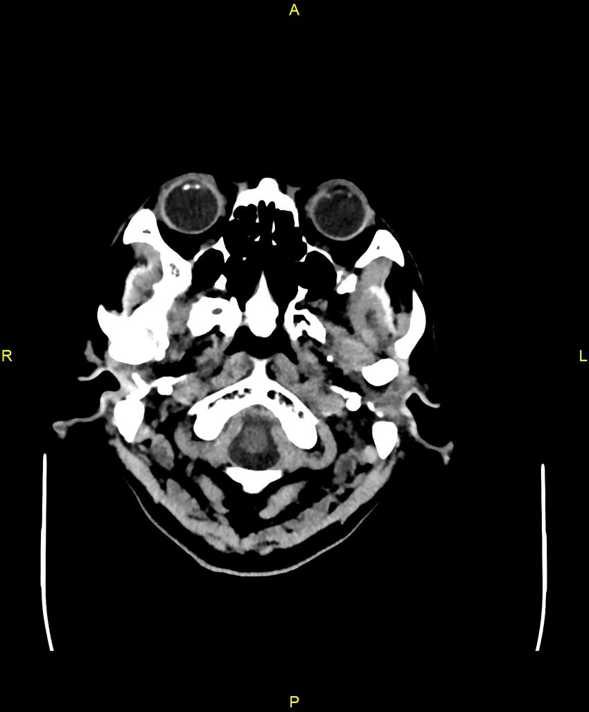 Bilateral isodense subdural hematomas (Radiopaedia 88621-105325 Axial non-contrast 6).jpg
