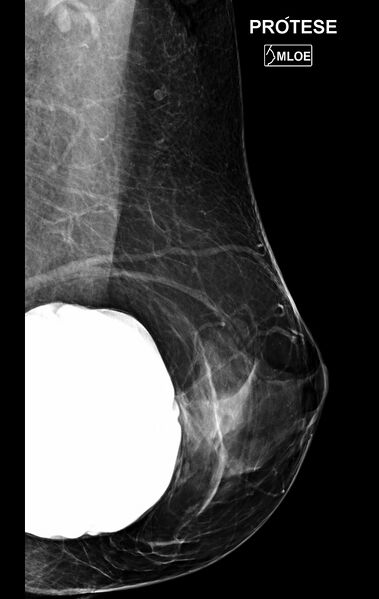 File:Bilateral mammoplasty (Radiopaedia 82984-97337 B 1).jpg