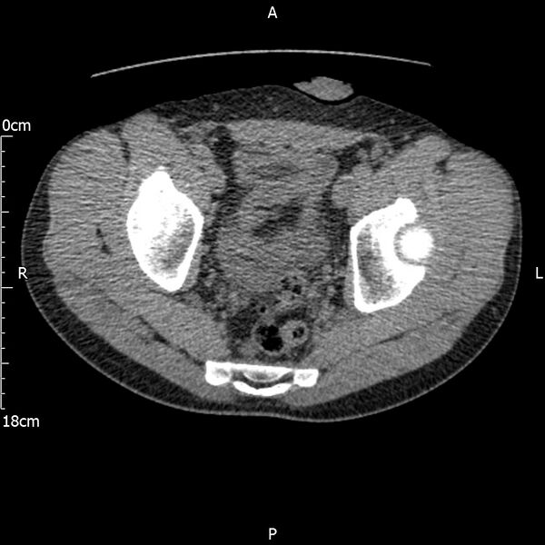 File:Bilateral medullary nephrocalcinosis with ureteric calculi (Radiopaedia 71269-81569 Axial non-contrast 118).jpg