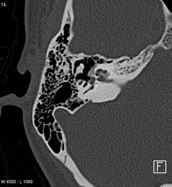 File:Bilateral otosclerosis with left stapes prosthesis (Radiopaedia 5567-7302 Axial bone window 8).jpg