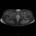 Bilateral ovarian fibroma (Radiopaedia 44568-48293 Axial T1 C+ fat sat 31).jpg