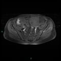 Bilateral ovarian fibroma (Radiopaedia 44568-48293 Axial T1 C+ fat sat 9).jpg