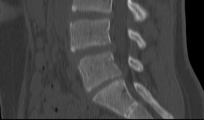 File:Bilateral pars defect (Radiopaedia 26691-26846 Sagittal bone window 34).jpg
