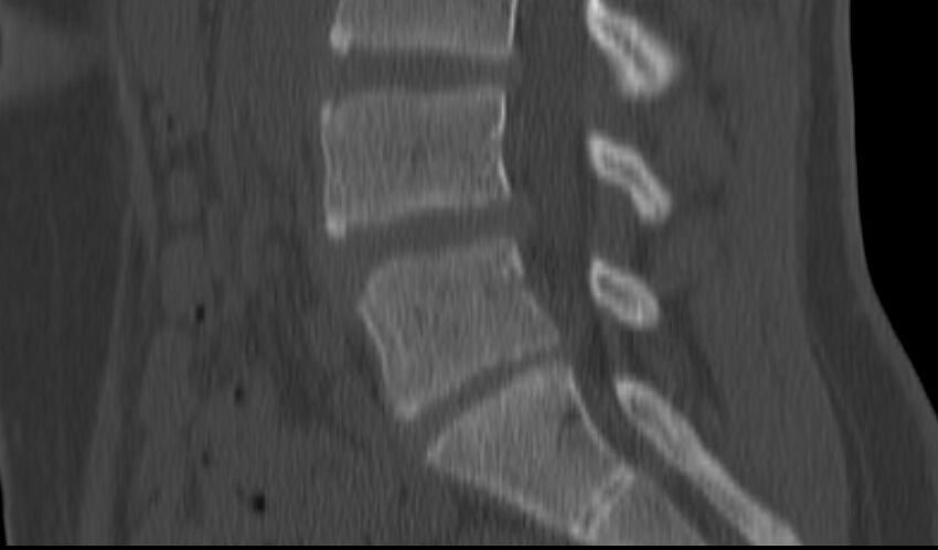 Bilateral pars defect (Radiopaedia 26691-26846 Sagittal bone window 34).jpg