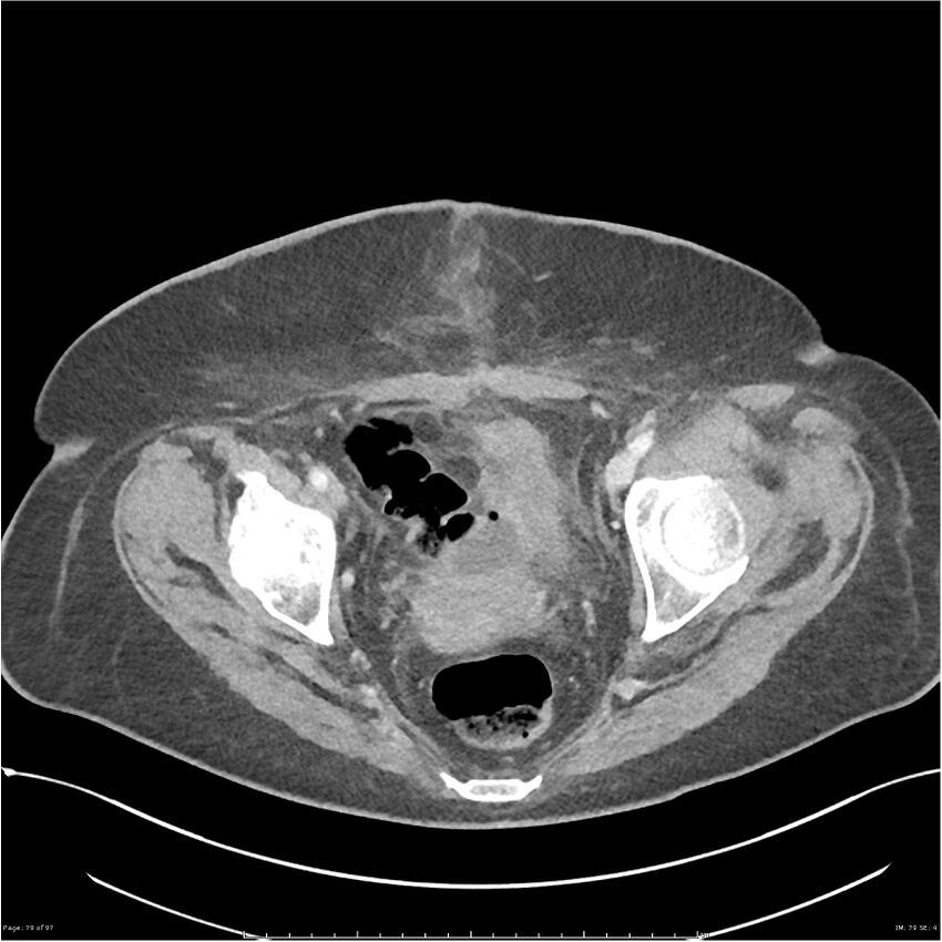 Bilateral psoas hematomas (Radiopaedia 24057-24279 A 79).jpg