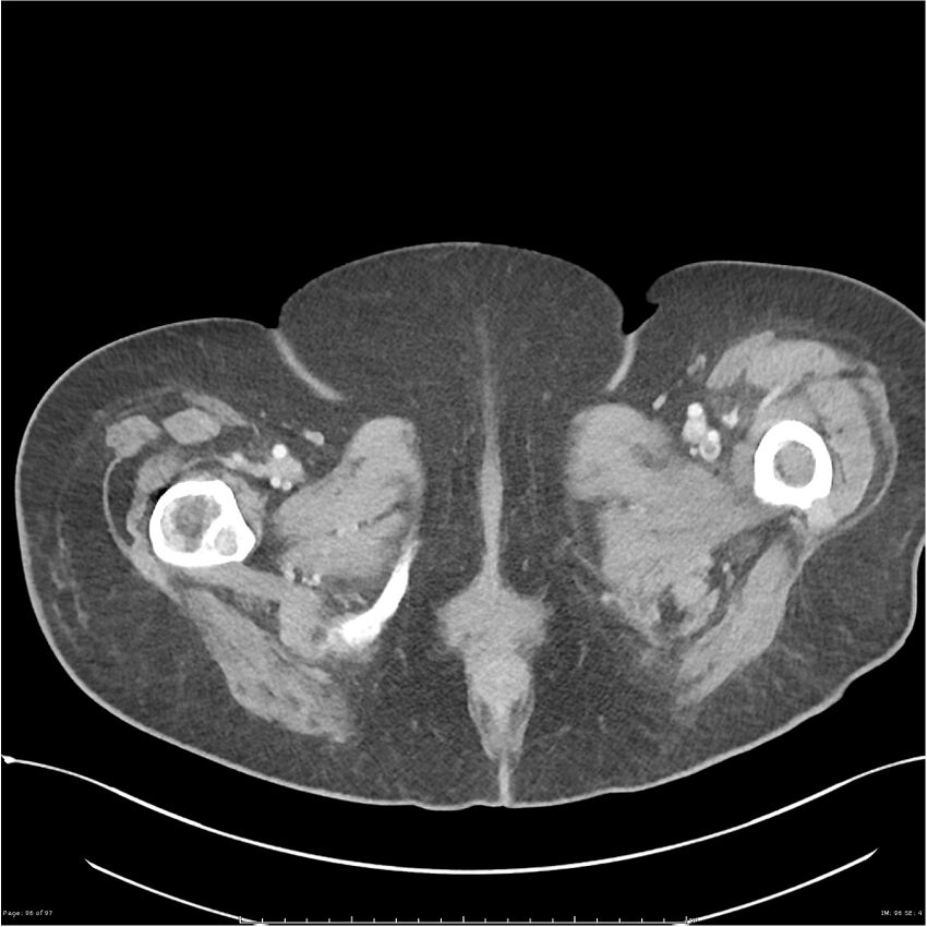 Bilateral psoas hematomas (Radiopaedia 24057-24279 A 97).jpg