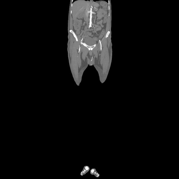 File:Bilateral superficial femoral arterial occlusion (Radiopaedia 25682-25857 Coronal MIP 11).jpg