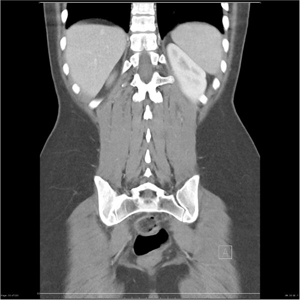 File:Bilateral ureteritis and cystitis (Radiopaedia 25340-25594 B 31).jpg