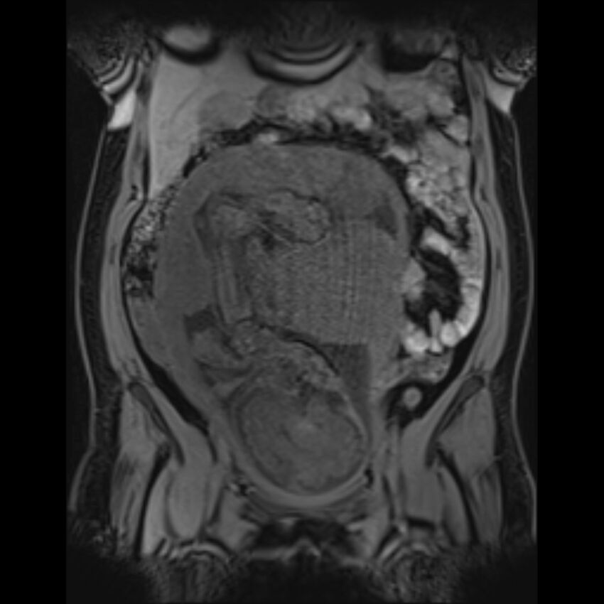 Bilobed placenta accreta (Radiopaedia 69648-79591 Coronal T1 vibe 77).jpg