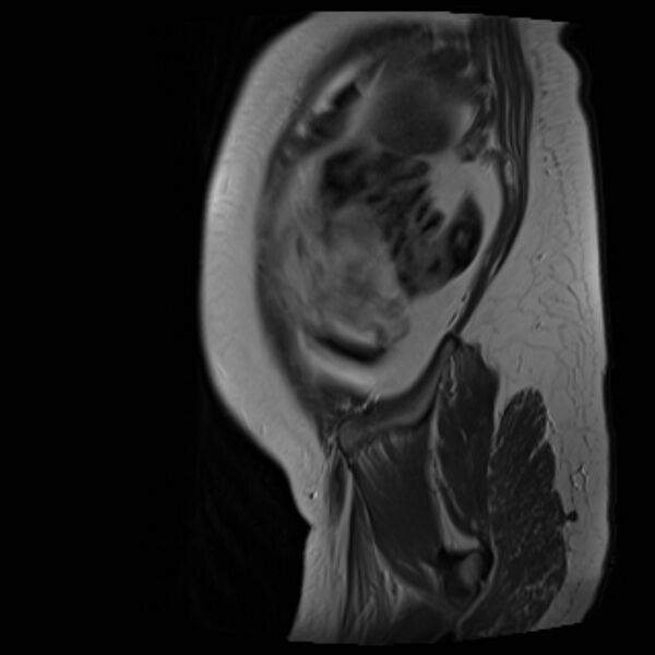 File:Bilobed placenta accreta (Radiopaedia 69648-79591 Sagittal T2 39).jpg
