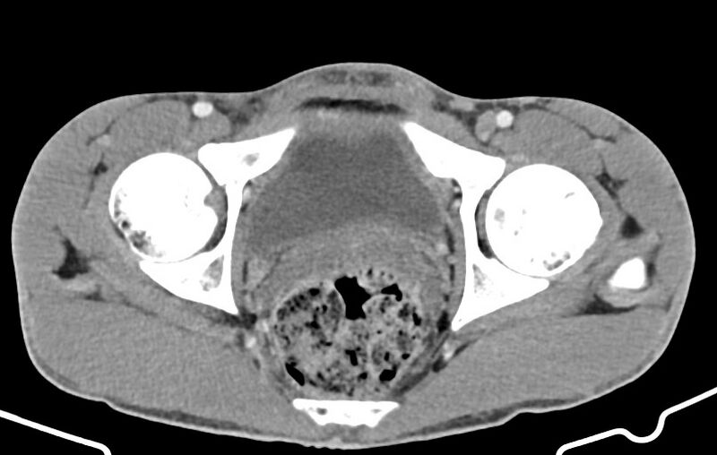 File:Blunt injury to the small bowel (Radiopaedia 74953-85987 A 184).jpg