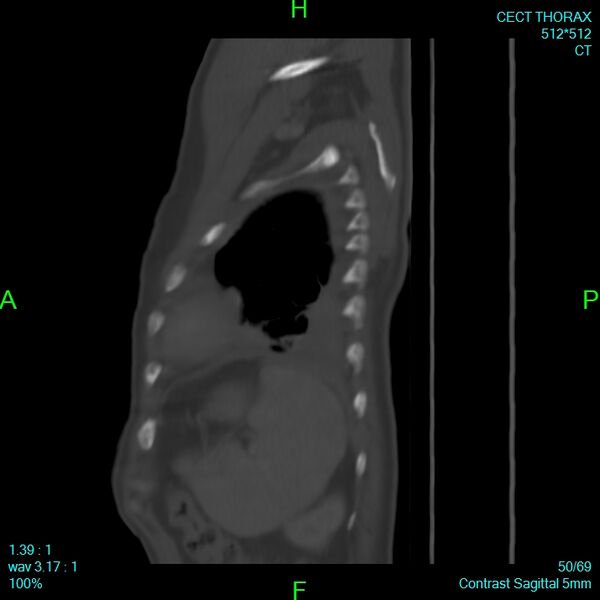 File:Bone metastases from lung carcinoma (Radiopaedia 54703-60937 Sagittal bone window 50).jpg