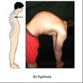 Bones and ligaments of the vertebral column (illustrations) (Radiopaedia 42770-45935 O 1).jpg