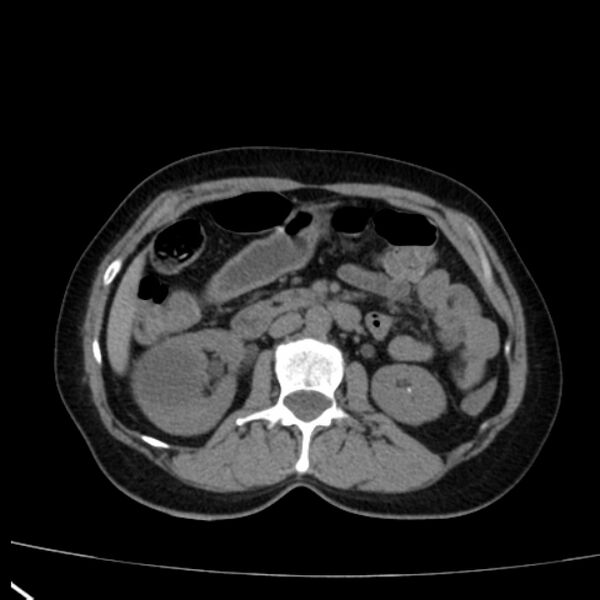 File:Bosniak renal cyst - type I (Radiopaedia 27479-27675 Axial non-contrast 38).jpg
