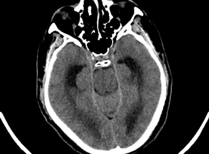 File:Brain abscess complicated by intraventricular rupture and ventriculitis (Radiopaedia 82434-96575 Axial non-contrast 9).jpg