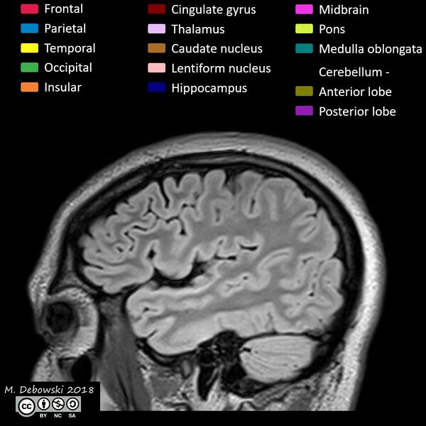 File:Brain lobes - annotated MRI (Radiopaedia 61691-69700 Sagittal 13).JPG
